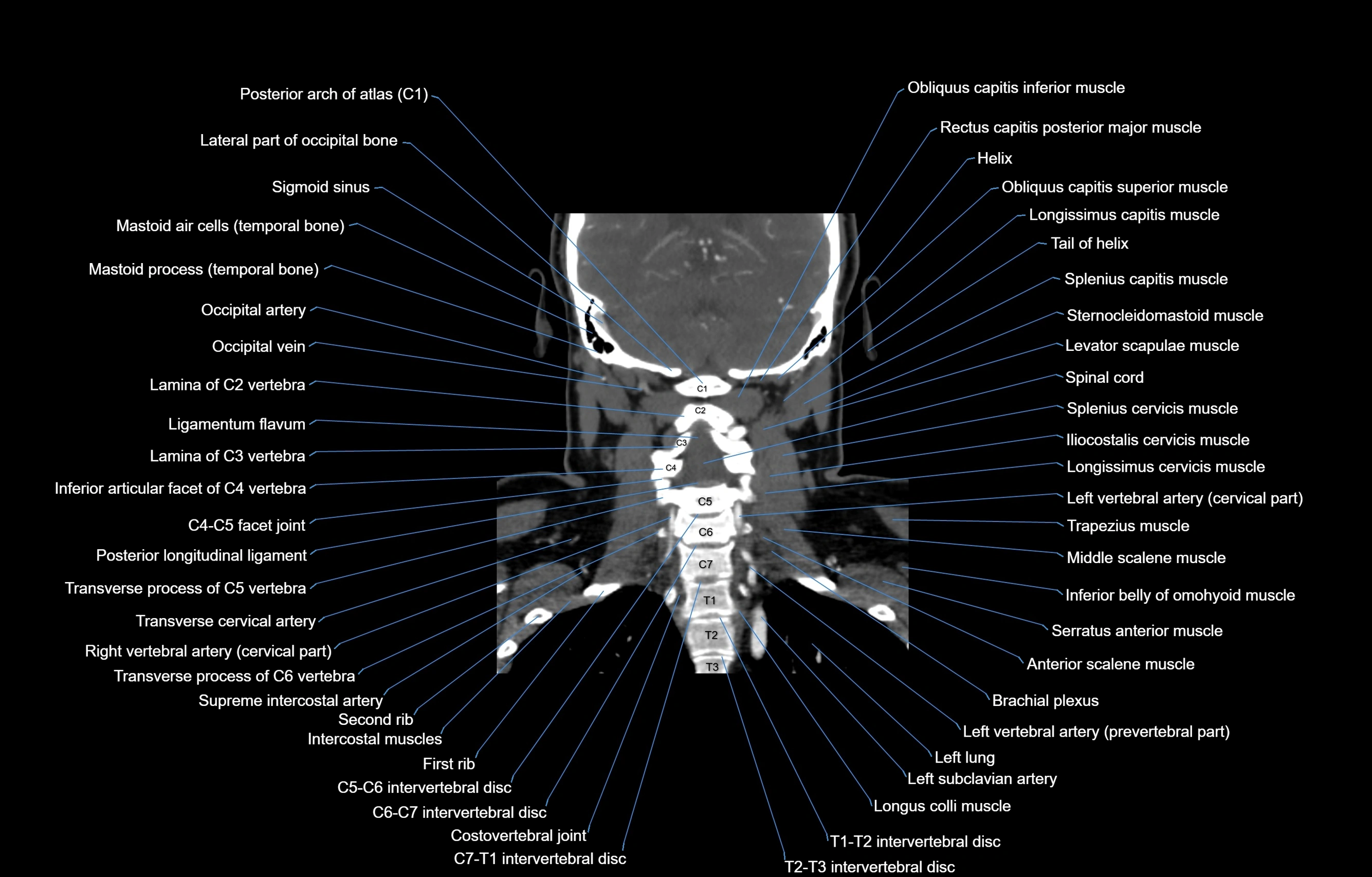 CT Neck coronal  cross sectional anatomy labelled 3D  radiology  image-00046.webp